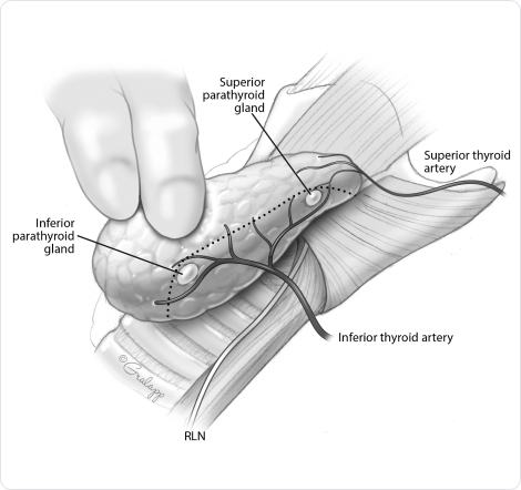 Risk of injury to the Recurrent Laryngeal Nerve Central Neck Dissection