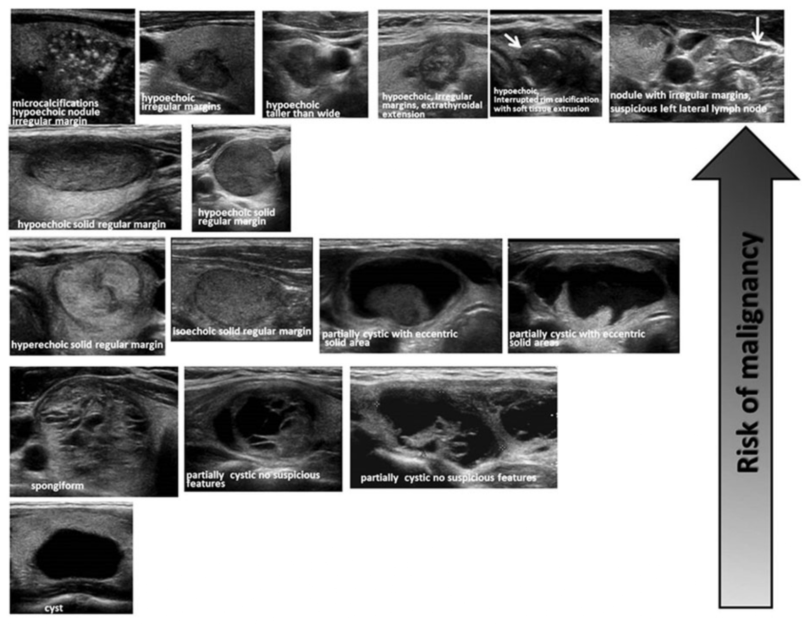 Ultrasound Appearance of Thyroid Nodules content-image