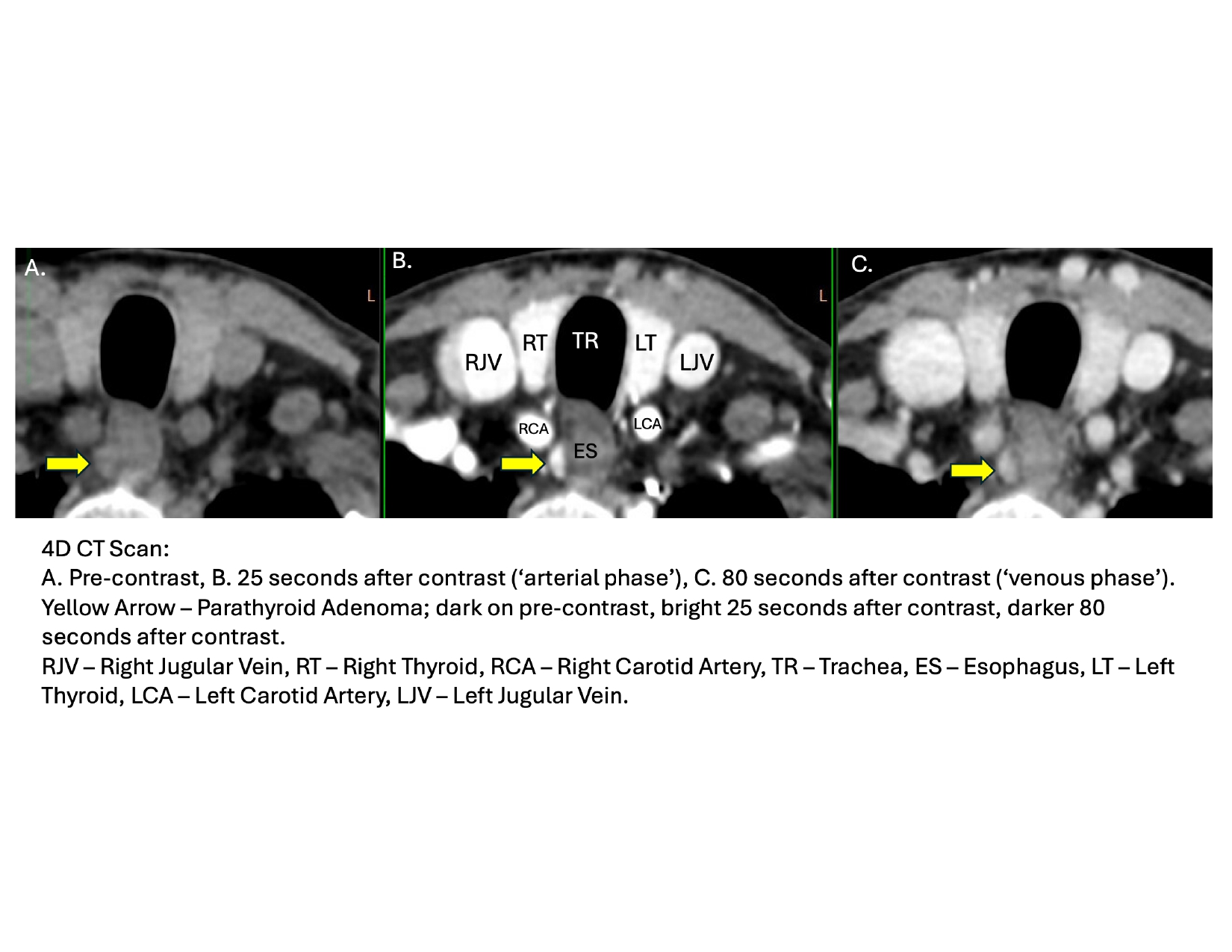 Parathyroid Ultrasound