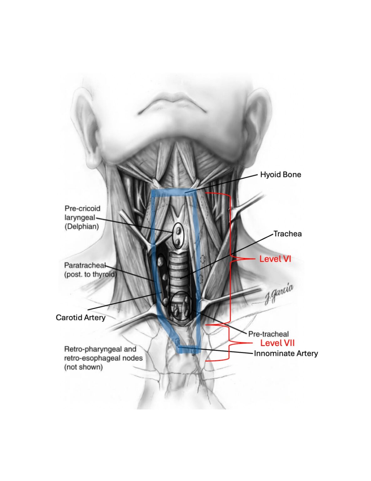Block Dissection Central Neck Dissection: Treatment Outcomes in Thyroid Cancer