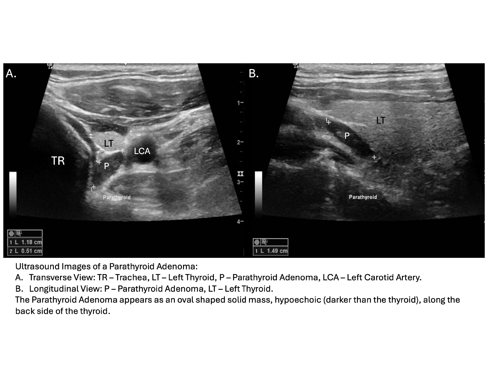 Parathyroid Ultrasound